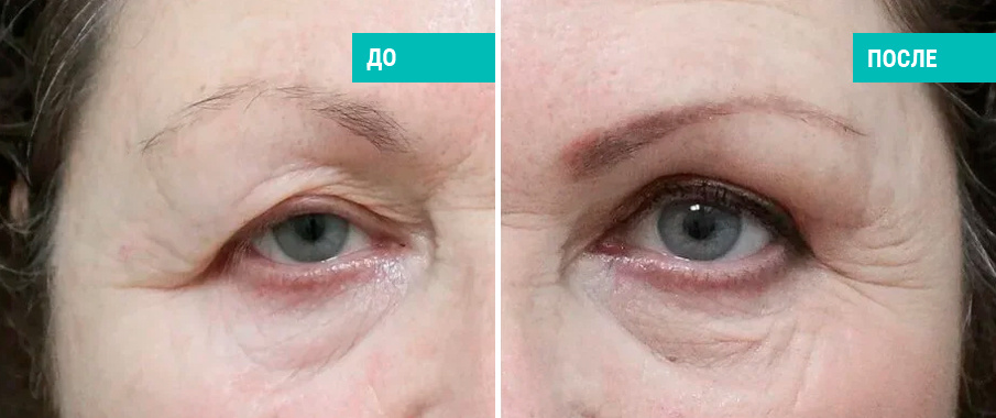 До и после блефаропластики. Пластический хирург Романютина Н. С.