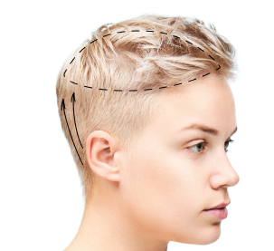 Пересадка волос у женщин