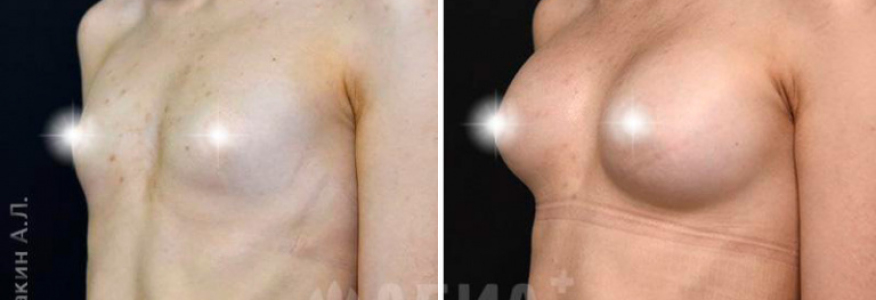 увеличение груди