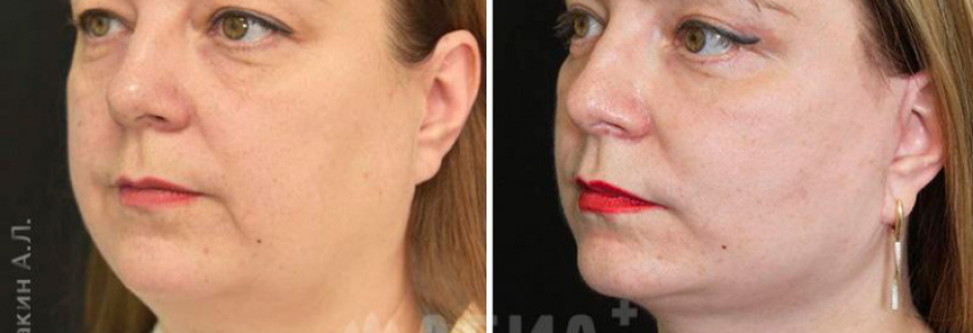 Лифтинг Мендельсона