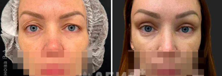 Эндоскопическая лобно-височная подтяжка 