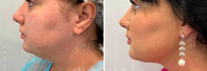 Липосакция подбородка с удалением комков биша