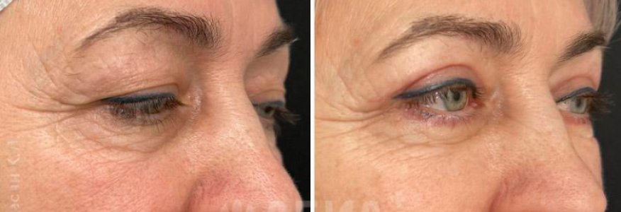 Блефаропластика