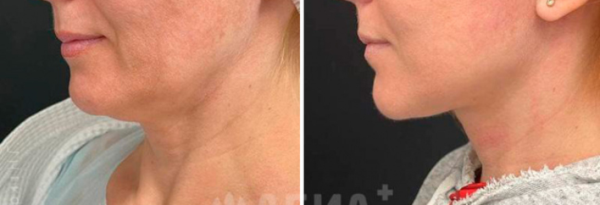 Подтяжка лица