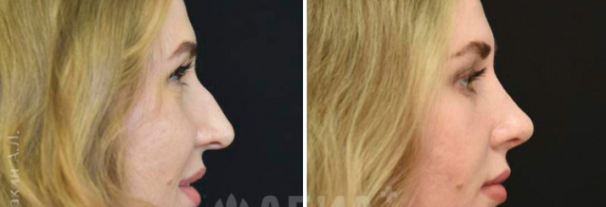 Риносептопластика