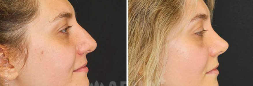 Ринопластика