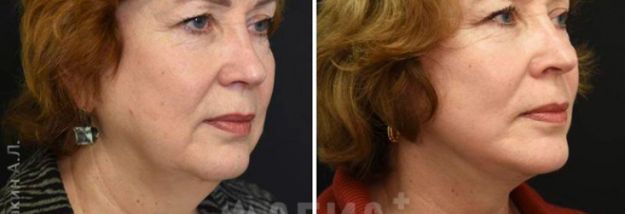 Лифтинг Мендельсона