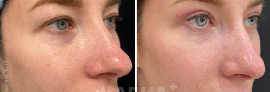 Верхняя блефаропластика