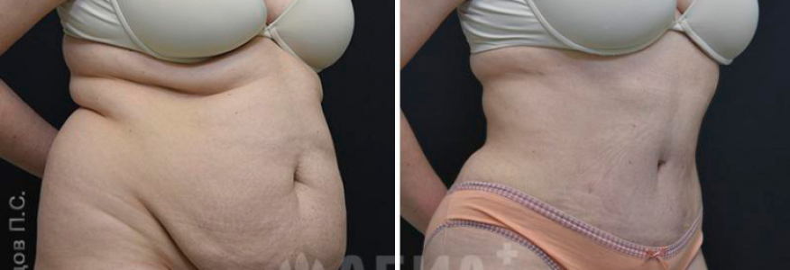 Скульптурирование тела