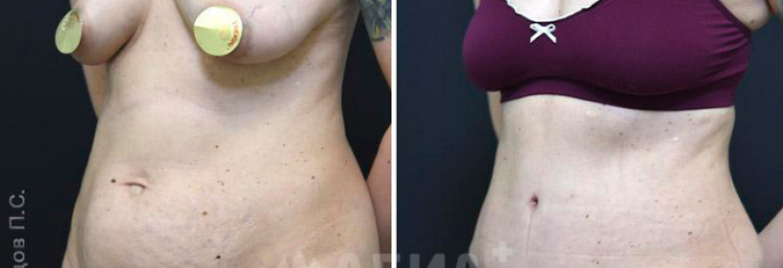 Абдоминопластика (пластика живота)