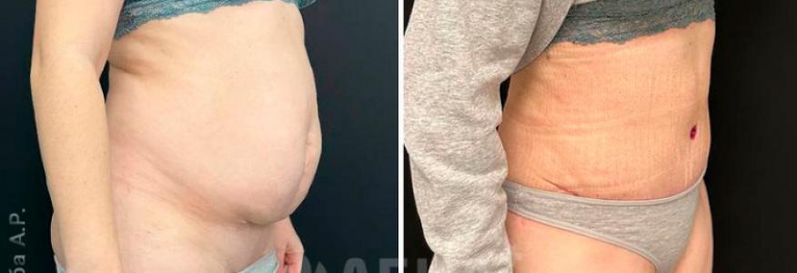 Абдоминопластика с липосакцией 