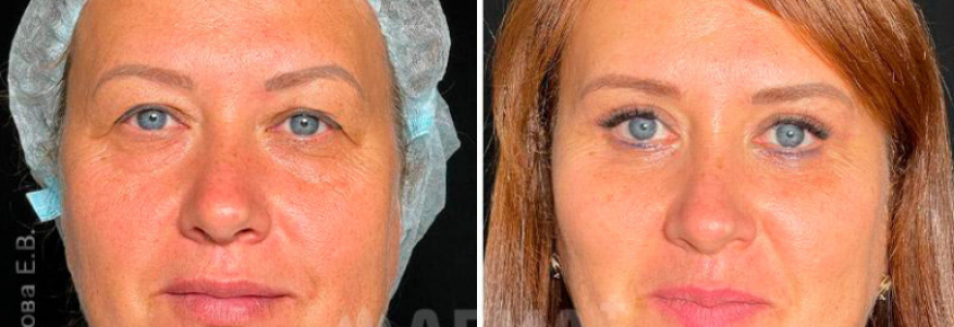 Чек-лифтинг, верхняя и нижняя блефаропластика, эндоскопическая подтяжка лба