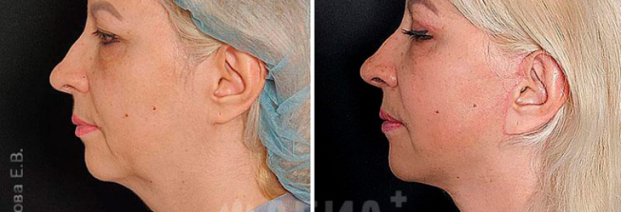 Подтяжка лица