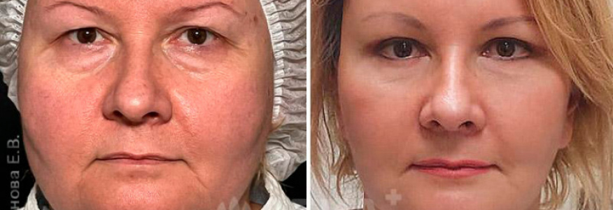 Фейслифтинг