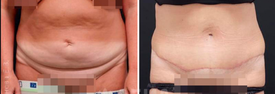 Абдоминопластика