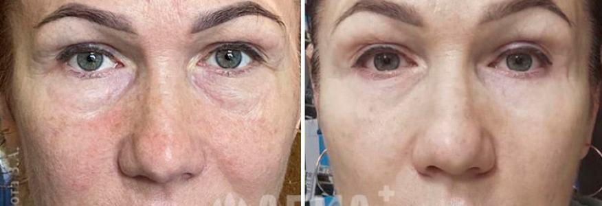 Нижняя блефаропластика