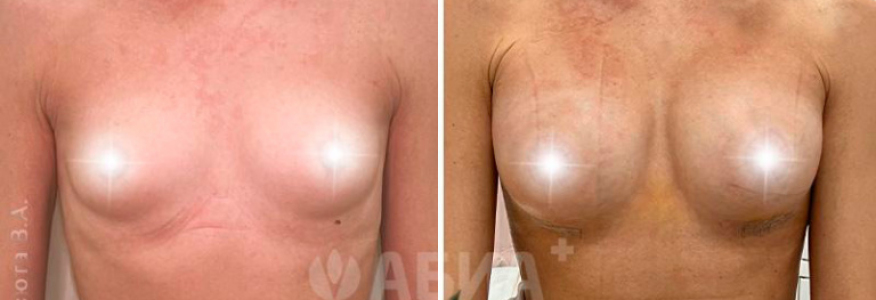 Увеличение груди