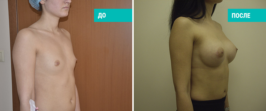 До и после увеличения груди. Пластический хирург А. А. Михайлов