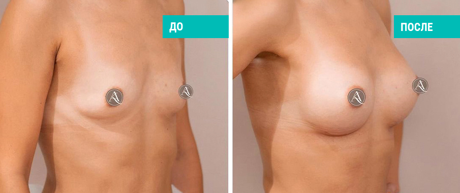 До и после увеличения груди. Пластический хирург А. н. Ковынцев