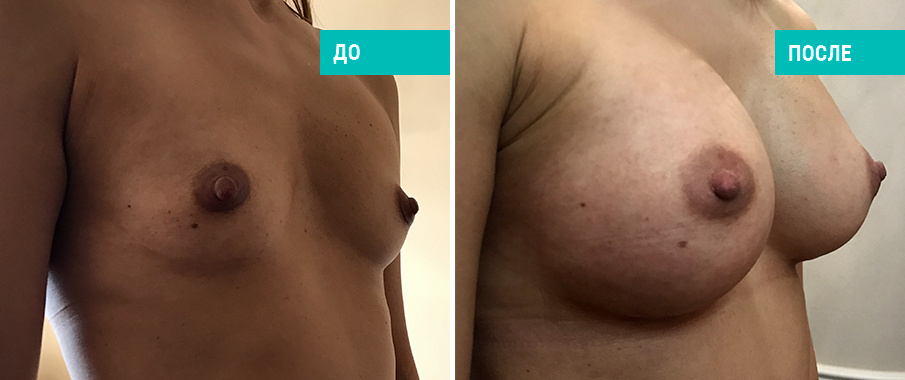 До и после увеличения груди. Пластический хирург Д. В. Крысин