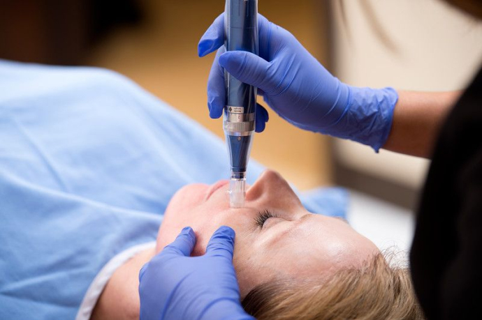 Косметологи отвечают на 10 самых популярных вопросов о микроиглах