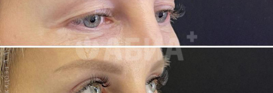 Блефаропластика