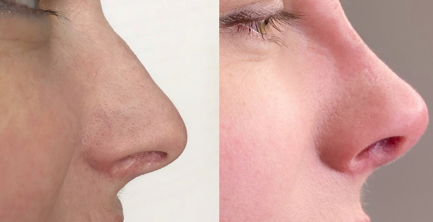 До и после коррекции нитями в косметологической клинике BEAUTY AVENUE