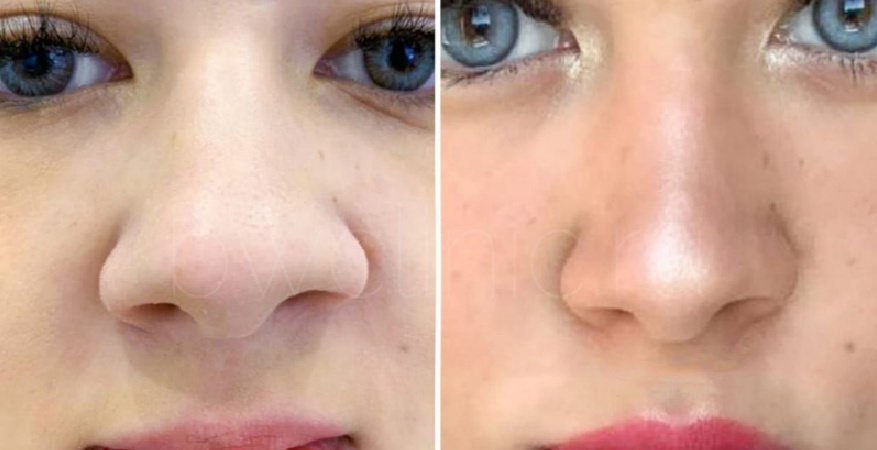 До и после коррекции в клинике BEAUTYWAY