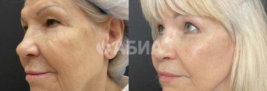 Подтяжка лица deep plane