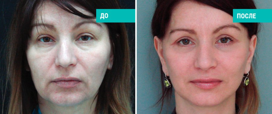 Спейслифтинг. Пластический хирург В. В. Наумов