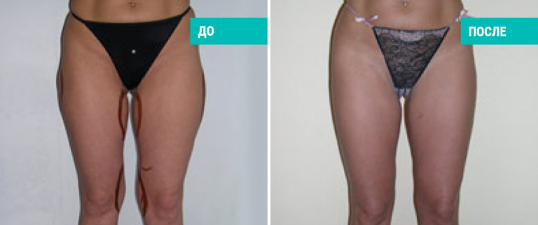 До и после липосакции. Пластический хирург В. Г. Якимец
