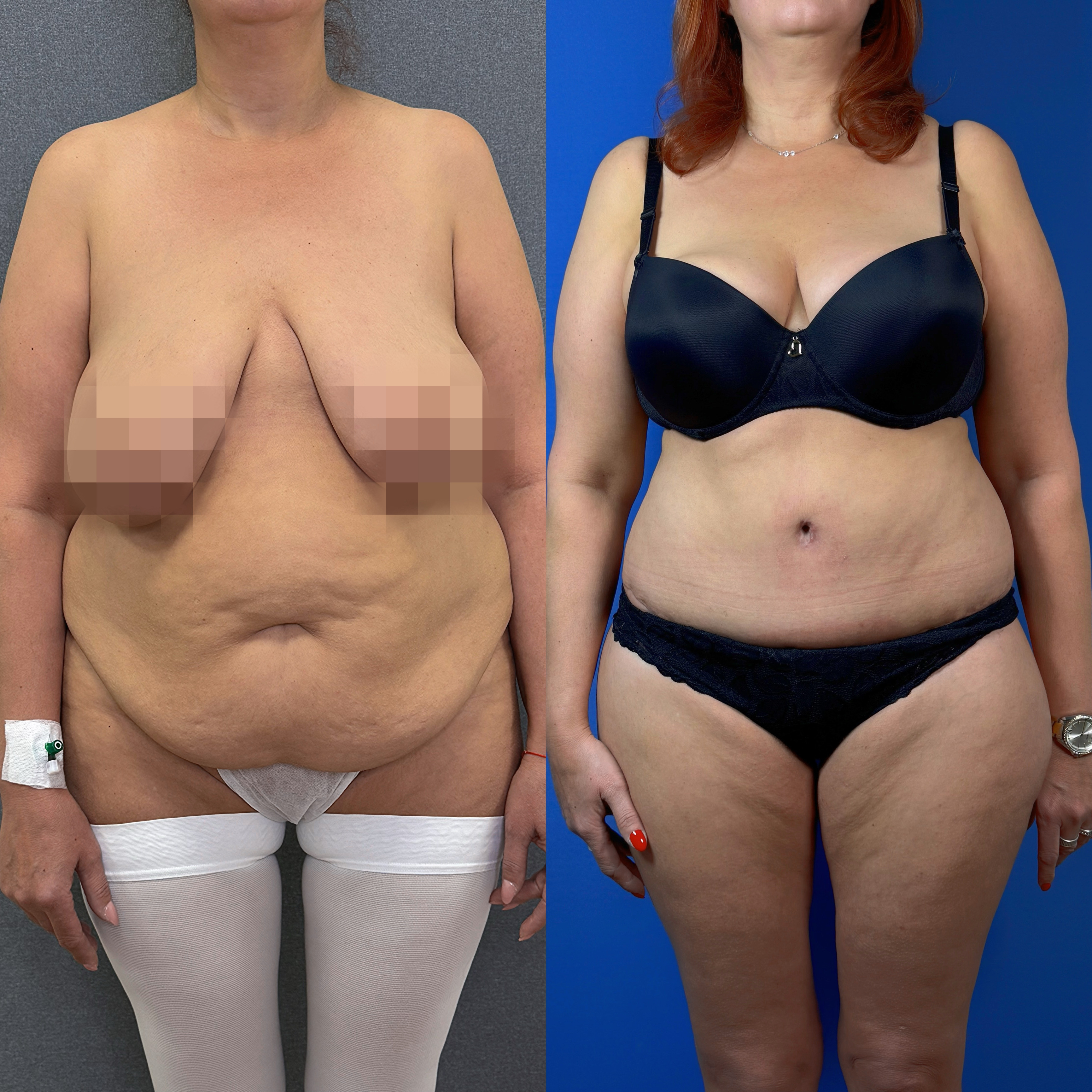 Выполнен нижний бодилифт. Пластический хирург Д. А. Лупин