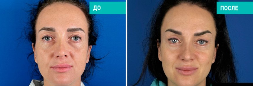 Комплексное омоложение