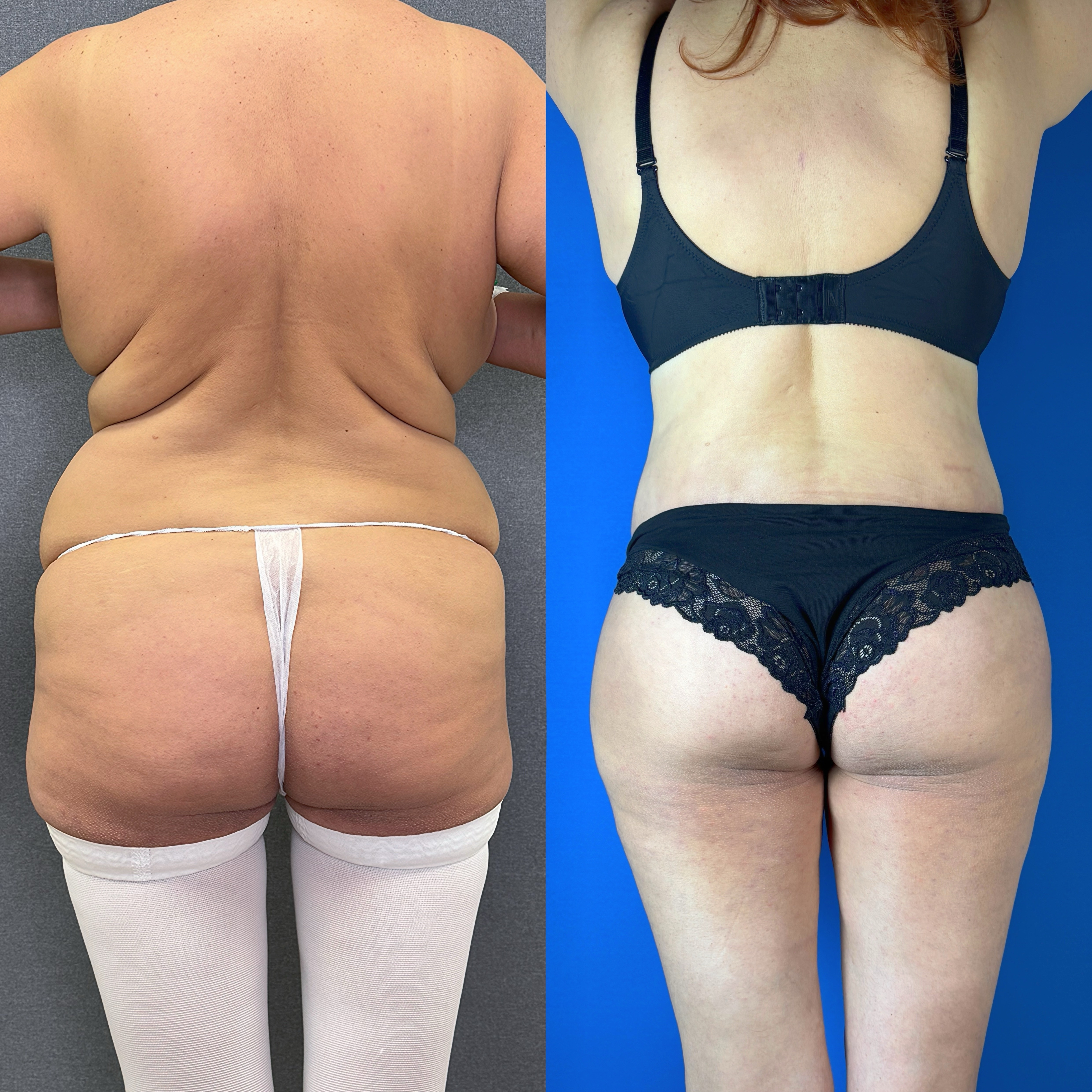 Выполнен нижний бодилифт. Пластический хирург Д. А. Лупин