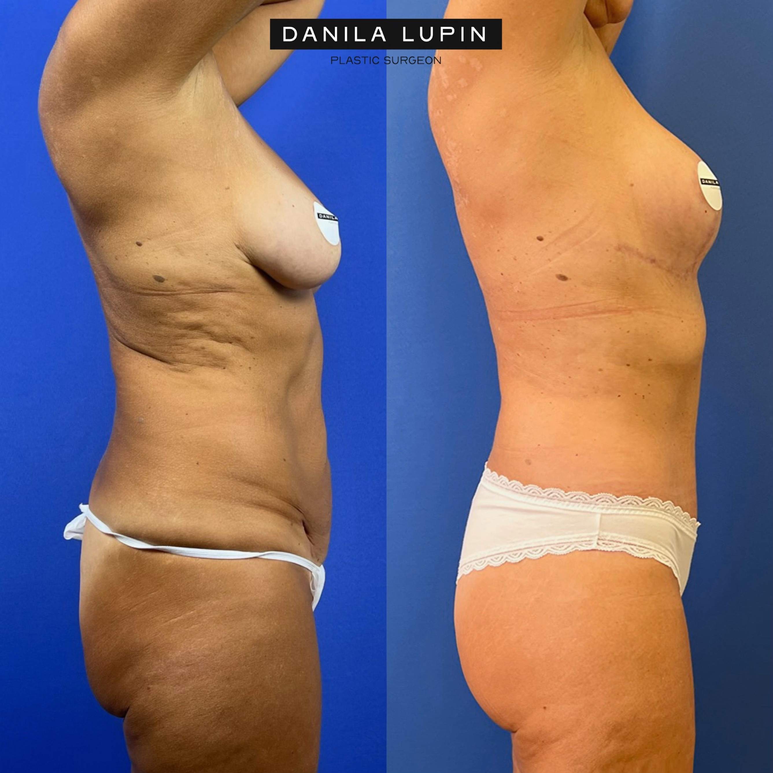 Выполнены бодилифт, подтяжка груди без имплантов, липофилинг ягодиц. Пластический хирург Д. А. Лупин