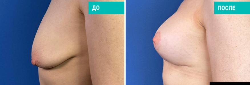 Подтяжка груди с установкой имплантов