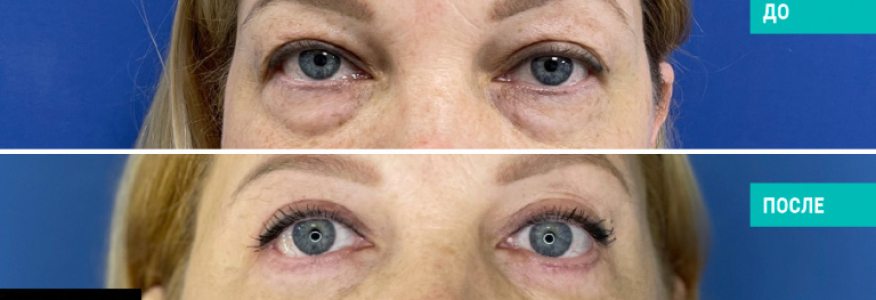 Круговая блефаропластика