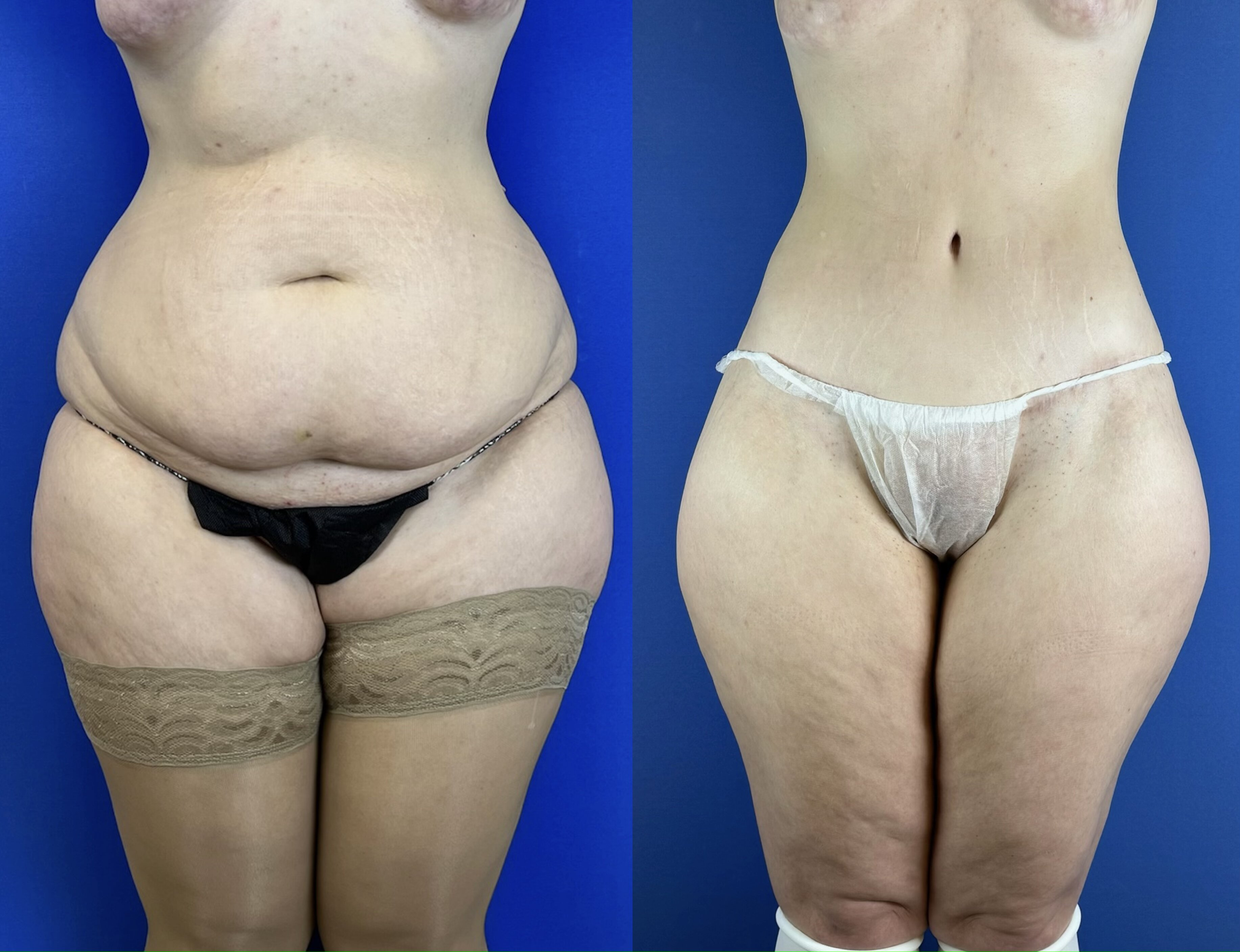 Выполнен нижний бодилифт (через год после операции). Пластический хирург Д. А. Лупин
