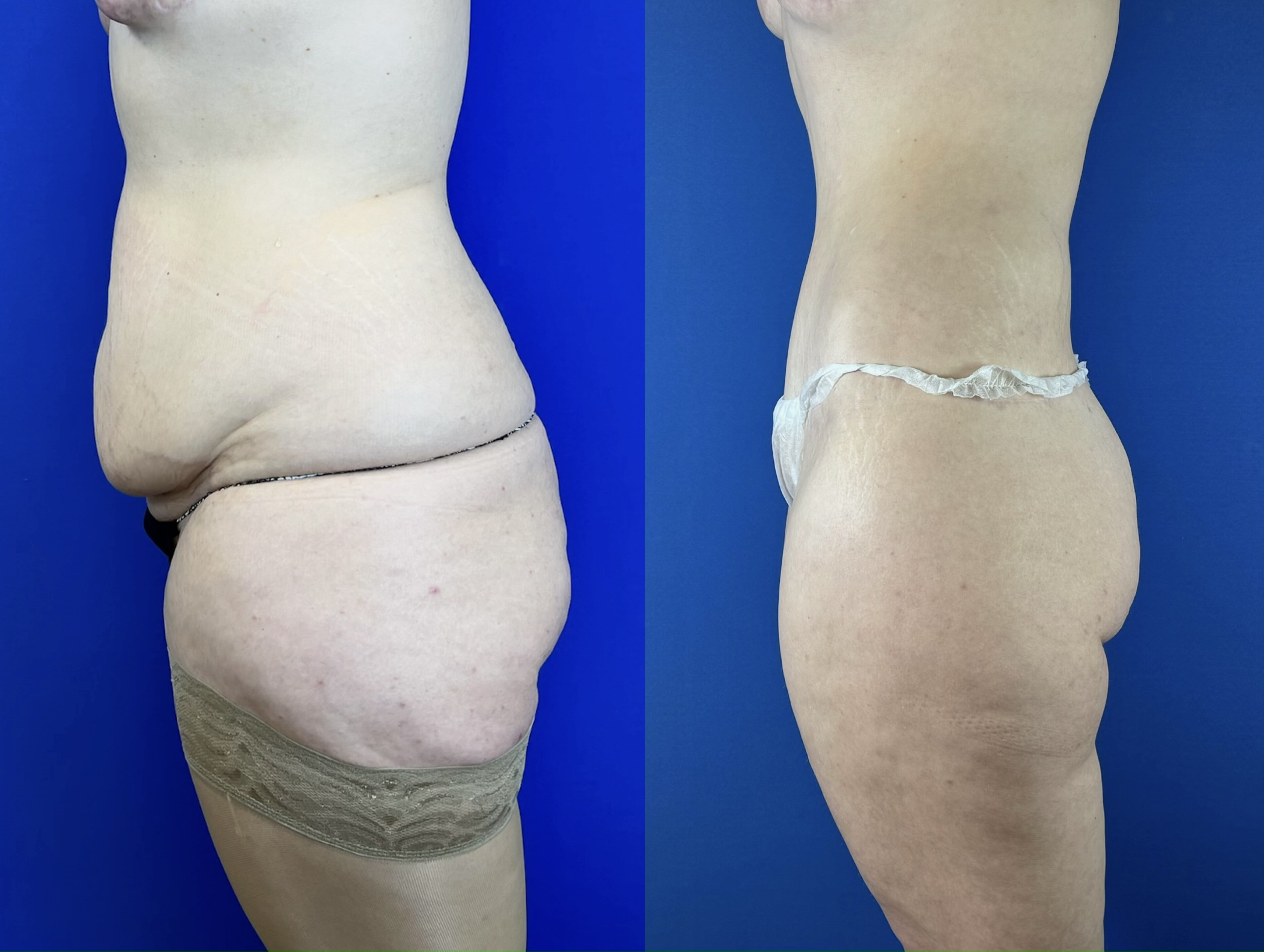 Выполнен нижний бодилифт (через год после операции). Пластический хирург Д. А. Лупин