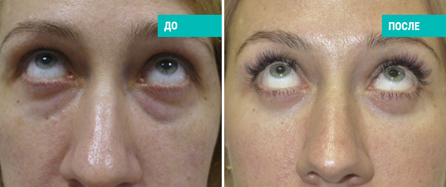 До и после блефаропластики. Пластический хирург А. А. Михайлов