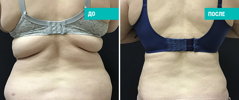 До и после липосакции. Пластический хирург О. А. Ованесова