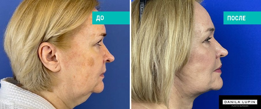 До и после подтяжки лица и шеи. Пластический хирург Д. А. Лупин