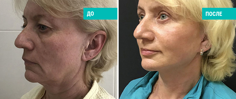 До и после подтяжки лица и шеи. Пластический хирург О. А. Ованесова