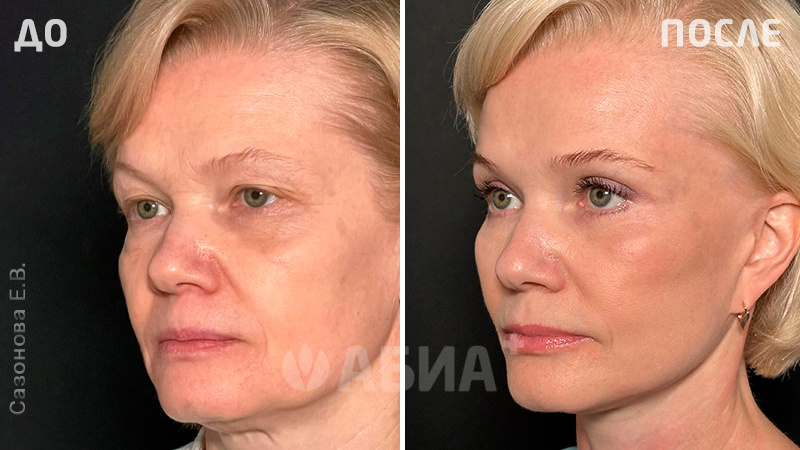 До и после фейслифтинга. Пациентка Е. В. Сазоновой