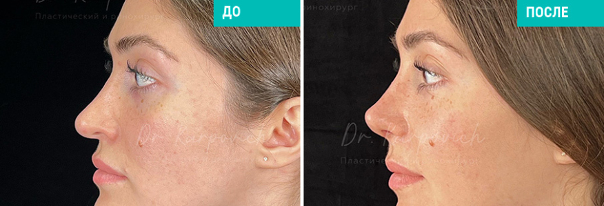 Ринопластика