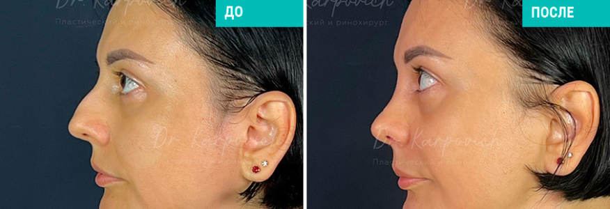 Ринопластика