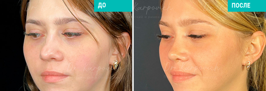 Ринопластика