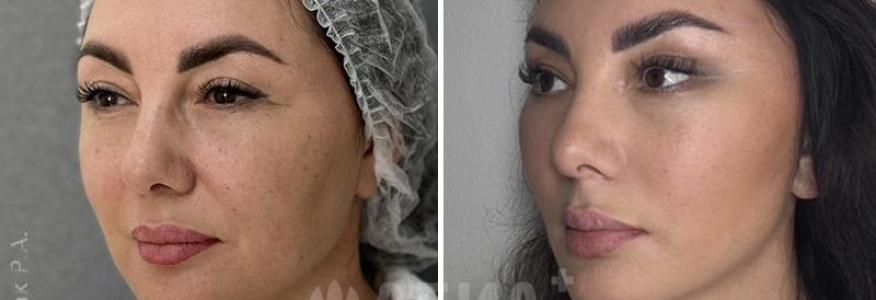 Пластика лица