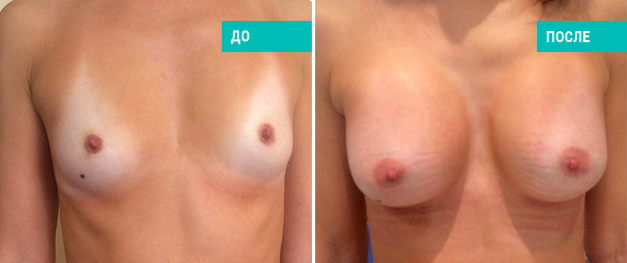 Пациентка Д. В. Крысина до и после маммопластики