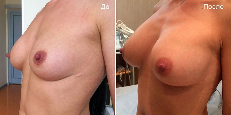 Пациентка Д. В. Крысина до и после маммопластики